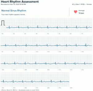 Fitbit Sense ECG Record