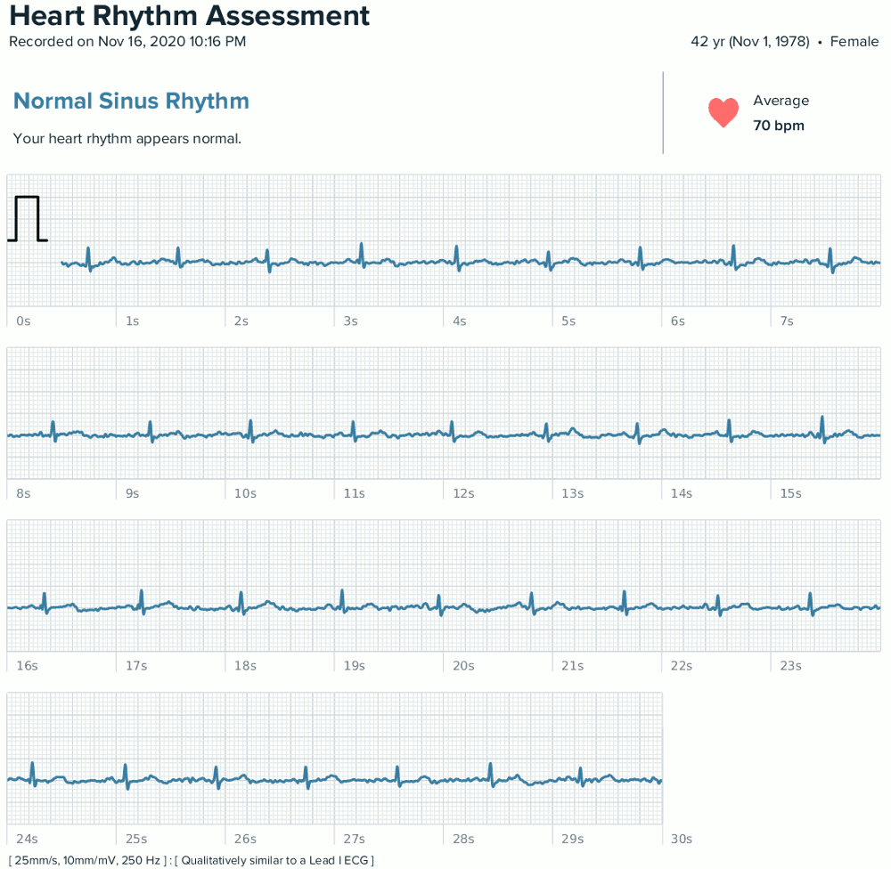 Ekg fitbit best sale