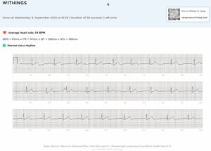 Withings ScanWatch: ECG report